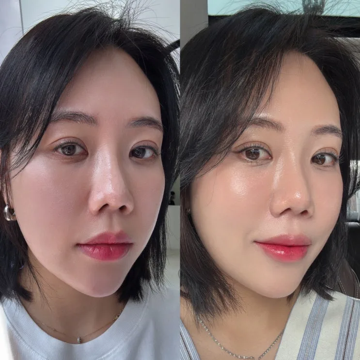 EMFACE Price & Review Near Cheongdam Station: Mid-Face Lifting Results