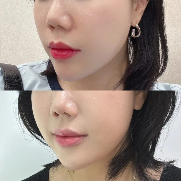 Ollidia 365 Volume Skin Booster Review for Sunken Cheeks at a KINTEX Dermatology Clinic in Goyang, South Korea