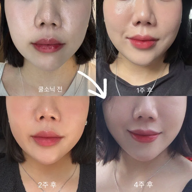 CoolSoniq Lifting Review: Painless Mid-Face Firming at a Gangnam Station Dermatology Clinic