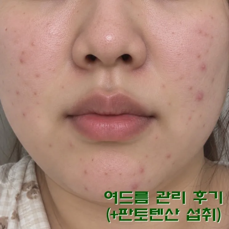 판토텐산 비타민B5 효능 비포애프터 리뷰
